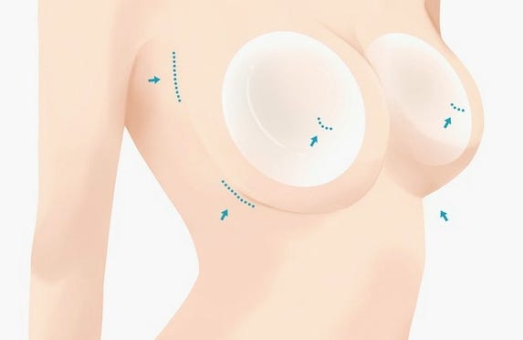 멘토가슴성형? 부작용 걱정된다면 알아야 할 '이것'