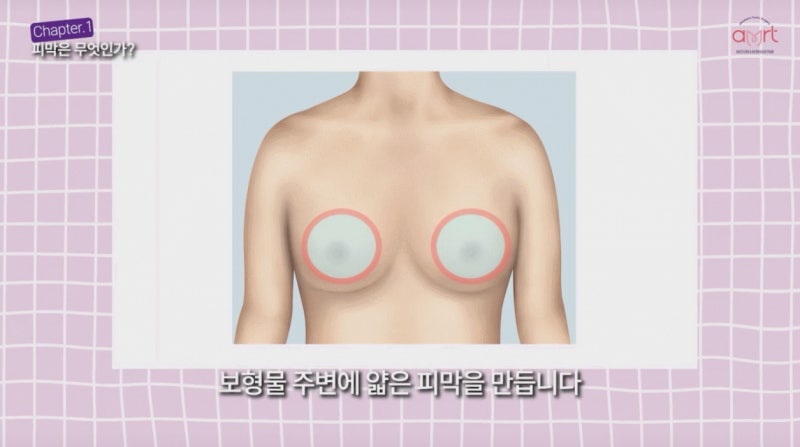 가슴재수술비용? 20년 경력 전문의가 드리는 조언 사진 6