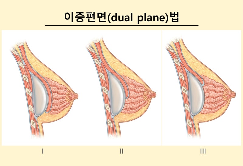 가슴확대수술? 10명 중 7명이 자주 하는 착각 2가지 사진 5