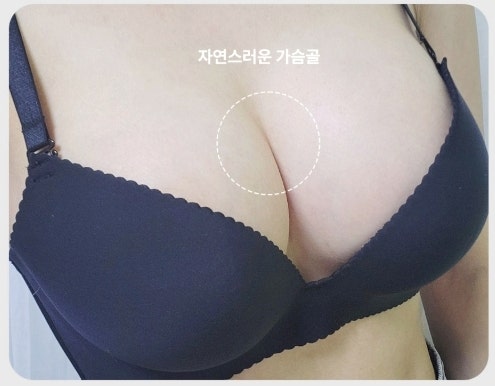 짝가슴수술, 양쪽 비대칭 교정하고 싶다면 보세요 사진 6