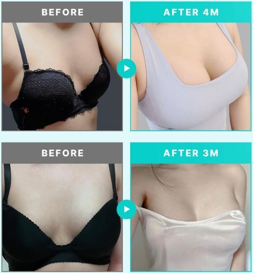 절벽가슴수술? 성형 후 티 나고 어색할까 걱정된다면 사진 6