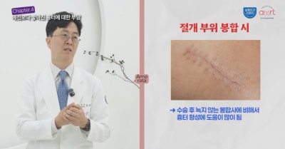 가슴수술 흉터, 겨드랑이 VS 밑선 절개 비교 사진 10