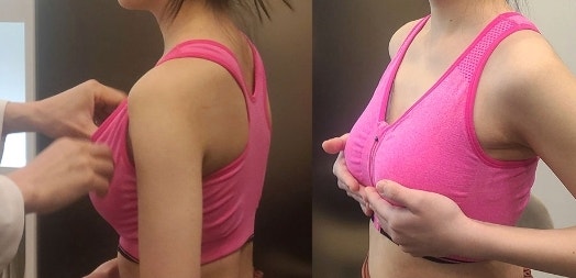 대전가슴수술, 멘토 vs 모티바 보형물 고민? 이 글로 종결합니다 사진 5