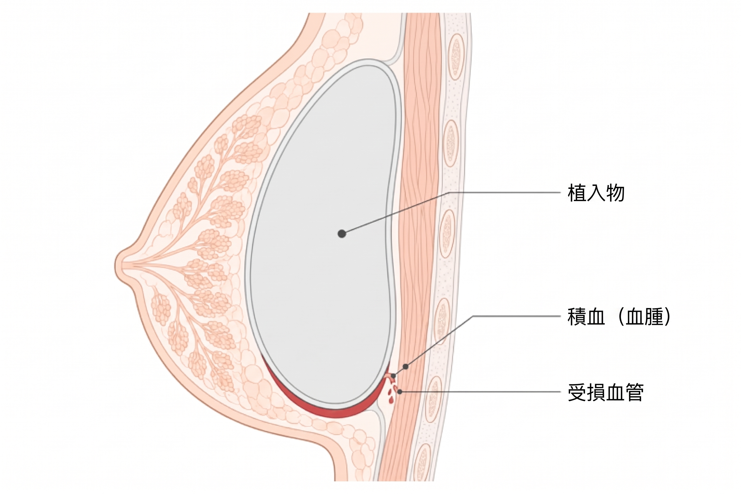 隆乳術後關鍵前2天，為什麼我堅持給患者我的私人電話？