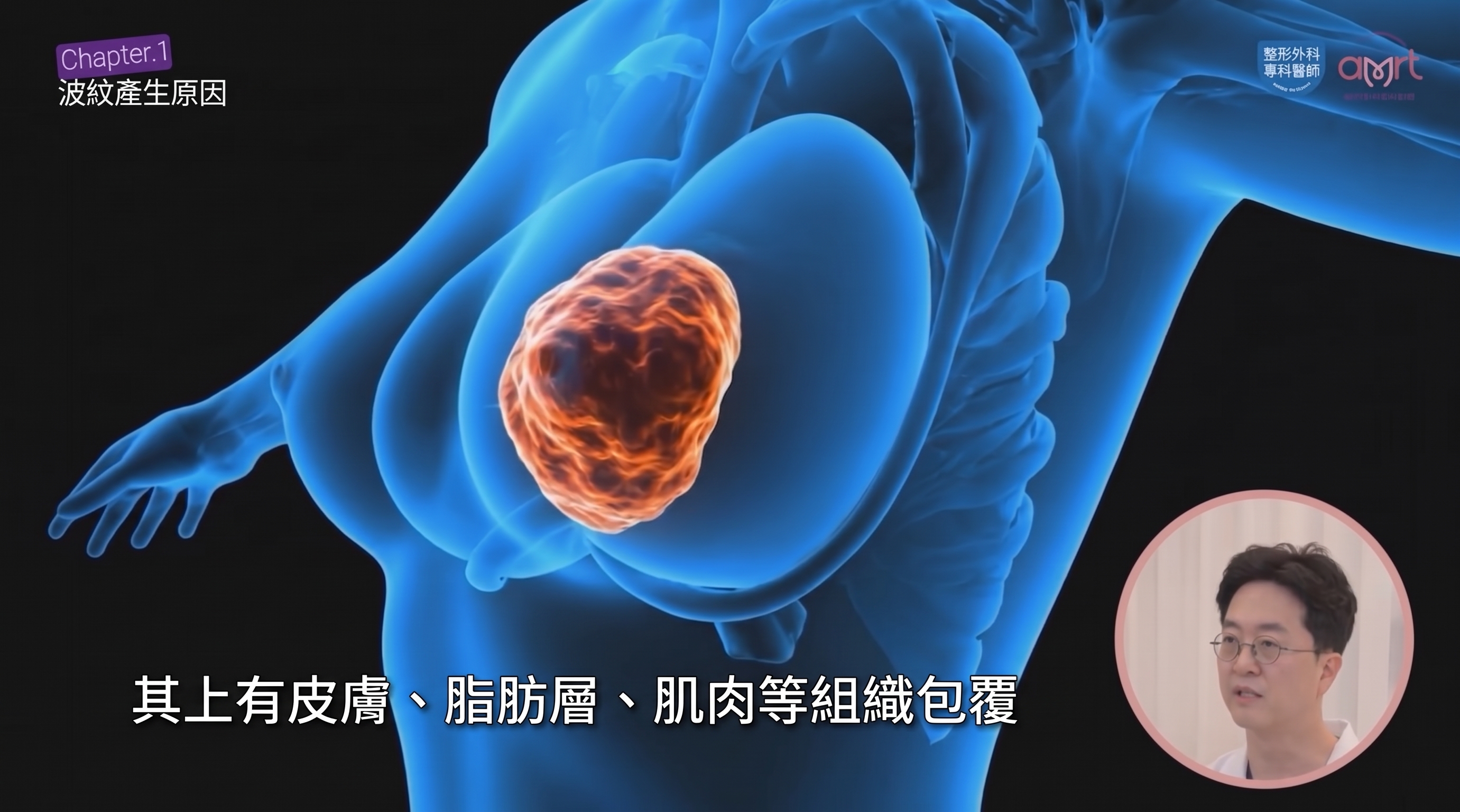隆乳水波紋（Rippling）成因解析，一定要做隆乳重修嗎？＜專科醫師解答＞ 사진 7