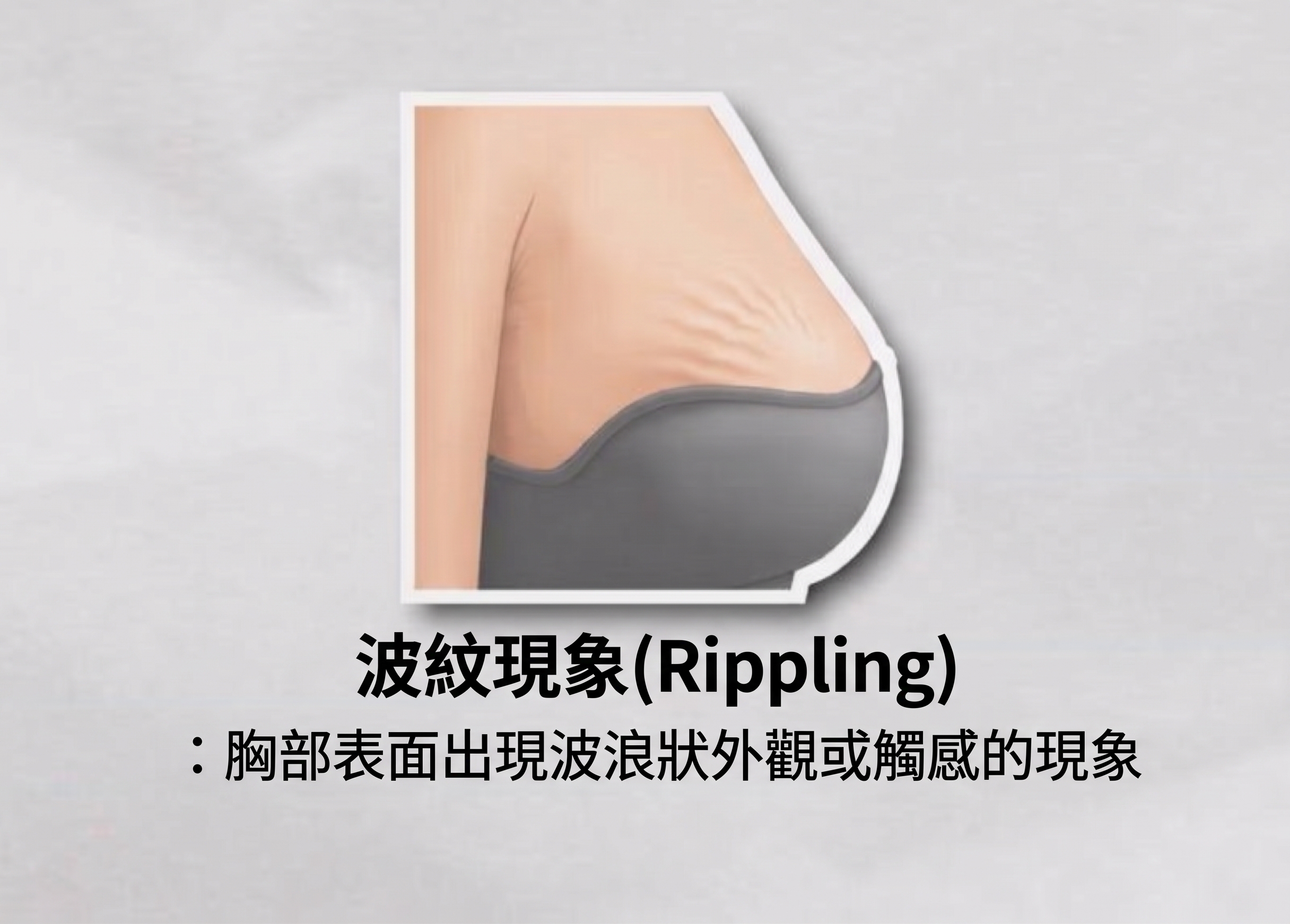 隆乳水波紋（Rippling）成因解析，一定要做隆乳重修嗎？＜專科醫師解答＞ 사진 5