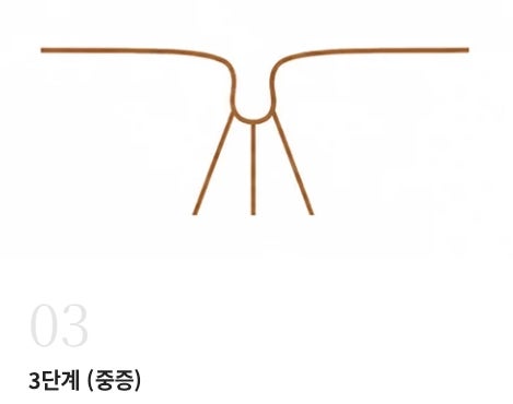 대전 함몰유두수술 병원, 실패 없는 선택을 위한 2가지 핵심 사진 6