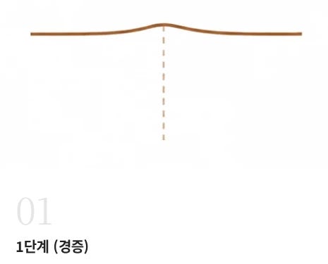 대전 함몰유두수술 병원, 실패 없는 선택을 위한 2가지 핵심 사진 4
