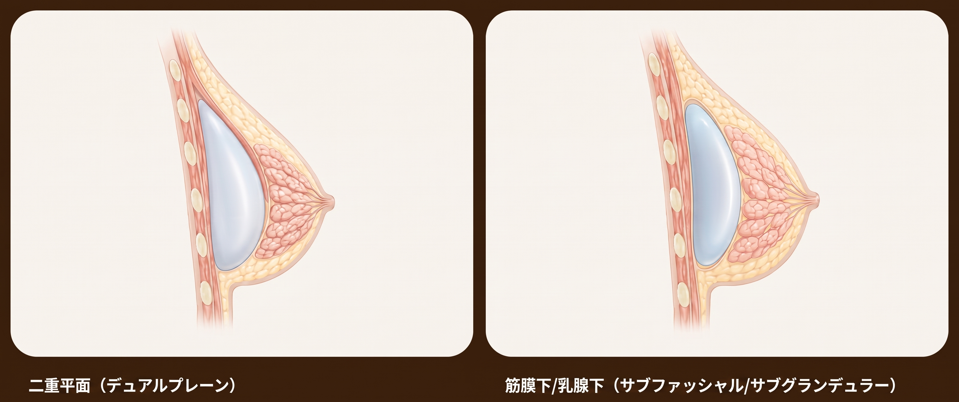 豊胸手術後に母乳育児は問題なく可能ですか？＜20年のキャリアを持つ医師の回答＞ 사진 4