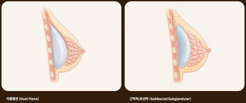가슴수술 후 모유 수유 문제없이 가능한가요? 사진 4