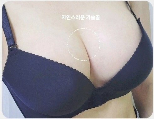 가슴 수술 보형물? 지방이식? 올바른 선택 기준 사진 10
