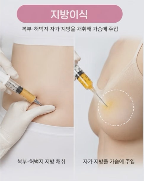 가슴 수술 보형물? 지방이식? 올바른 선택 기준 사진 5