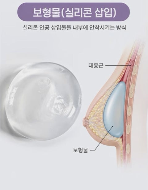 가슴 수술 보형물? 지방이식? 올바른 선택 기준 사진 7