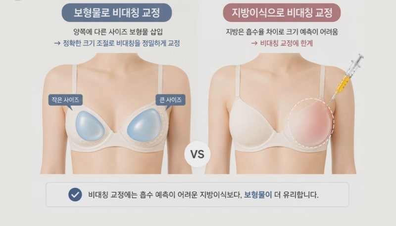 가슴 수술 보형물? 지방이식? 올바른 선택 기준