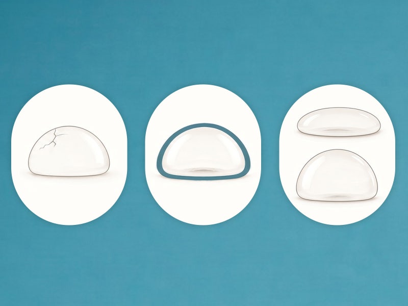 Where Did the 10-Year Breast Implant Replacement Rule Come From? A Guide to When to Replace 사진 2